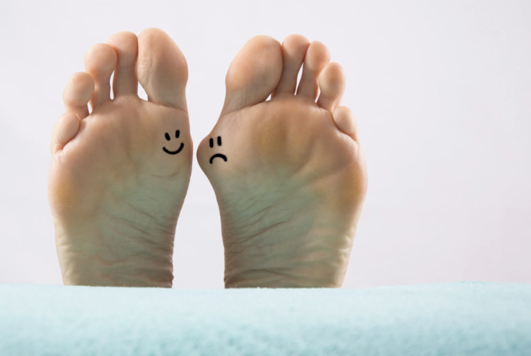 Hallux valgus – ko palec na stopalu spremeni smer